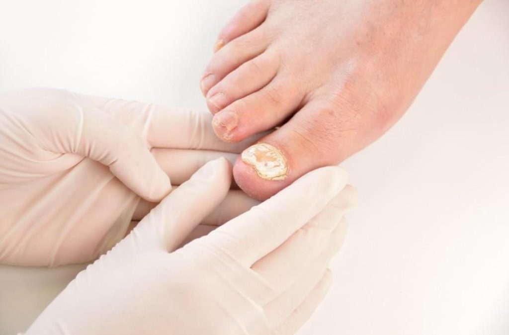 A Few Things to Remember About Toenail Fungus